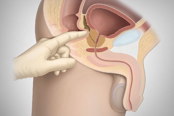 Masaxe de próstata para a prostatite bacteriana