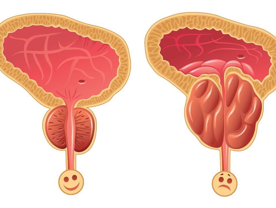 Glándula prostática saudable e conxestión prostática con prostatite conxestiva
